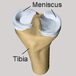  Meniscus: biodegradable polyurethane 